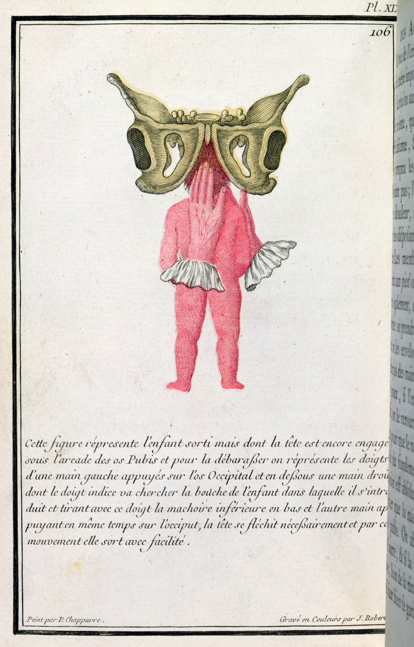 Diagrama seccional de un bebé extraído del útero, de un libro de Madame Angelique Le Boursier du Coudray, grabado por J. Robert, 1783 de P. Chapparre