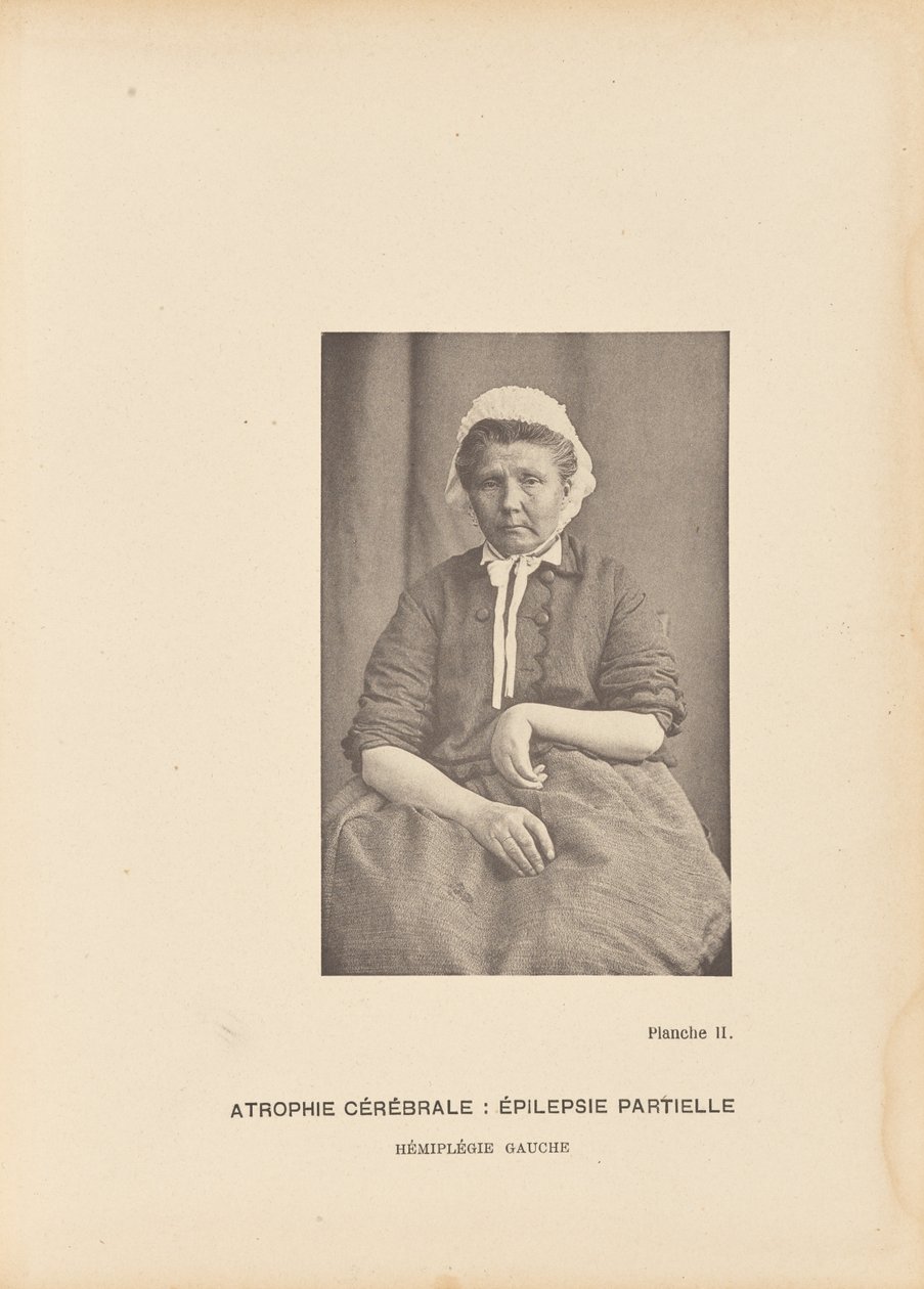 Atrofia cerebral: Epilepsia parcial Hemiplejia izquierda de Paul Marie Léon Regnard