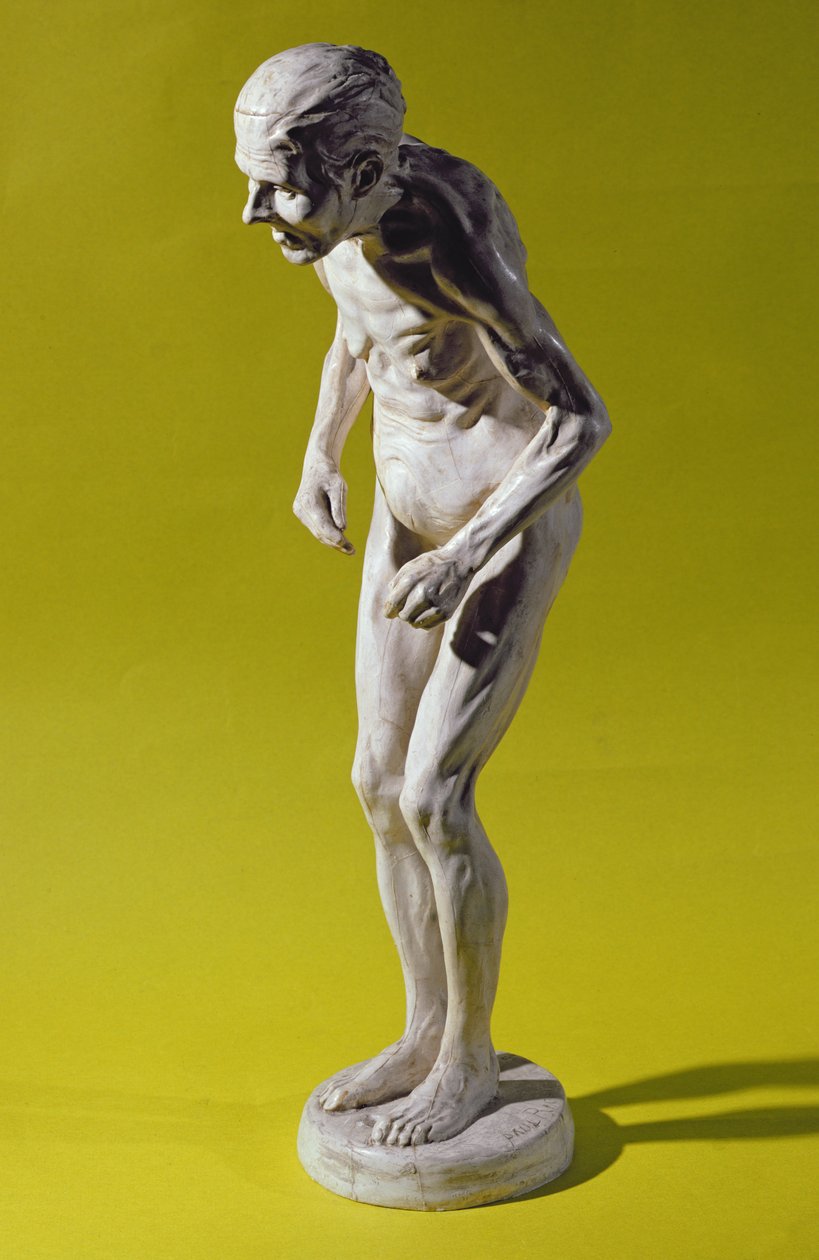 Figura de una mujer con enfermedad de Parkinson de Paul Marie Louis Pierre Richer