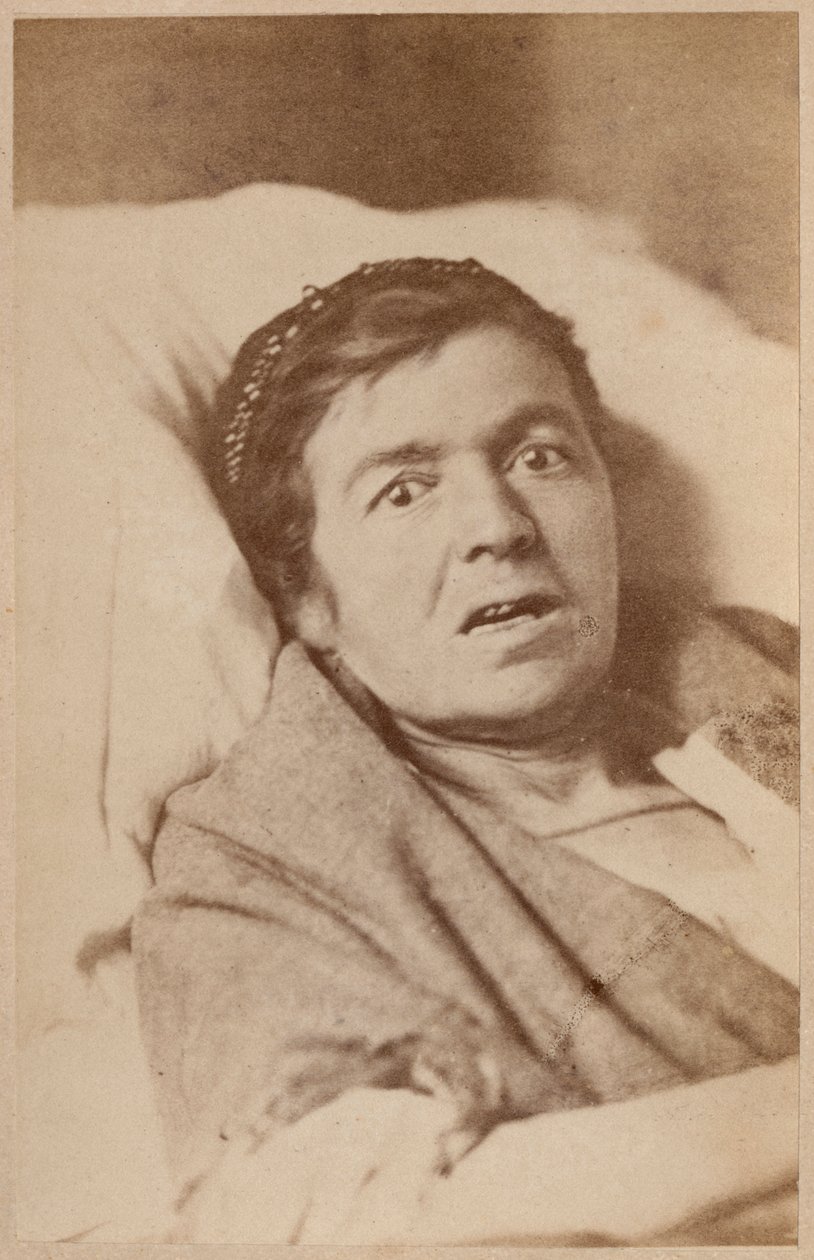 Epilepsia histérica, contracción facial, lámina VIII de 