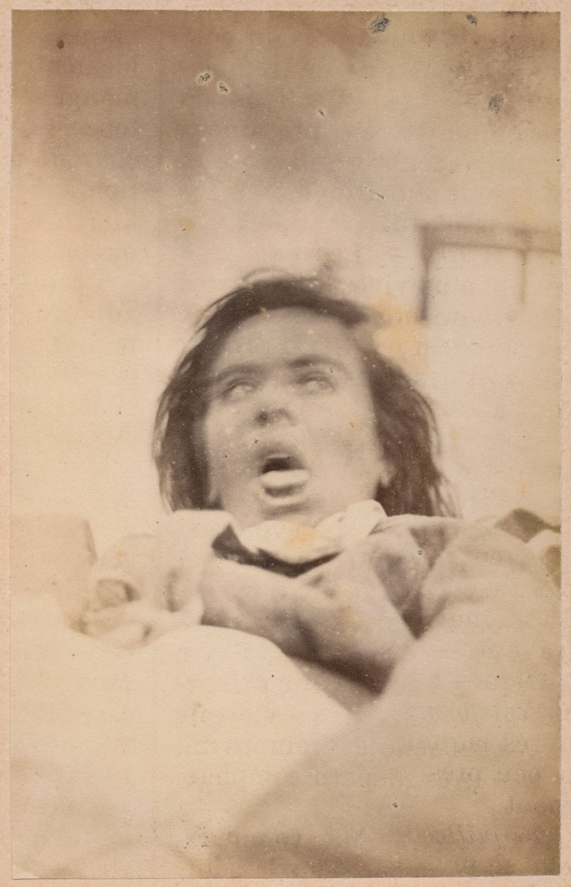 Epilepsia histérica, alucinaciones, angustia, lámina XXIX de 