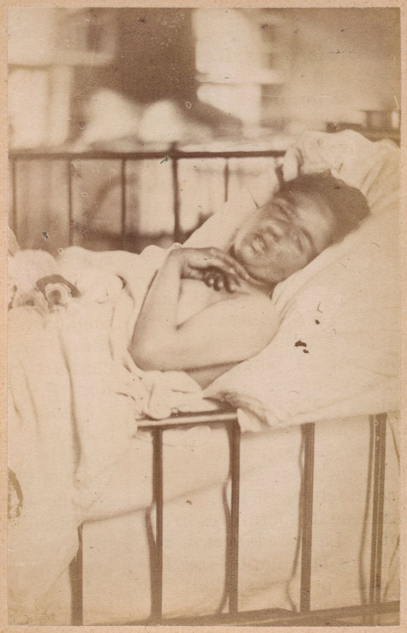 Epilepsia histérica, contracción permanente, lámina XXVIII de 