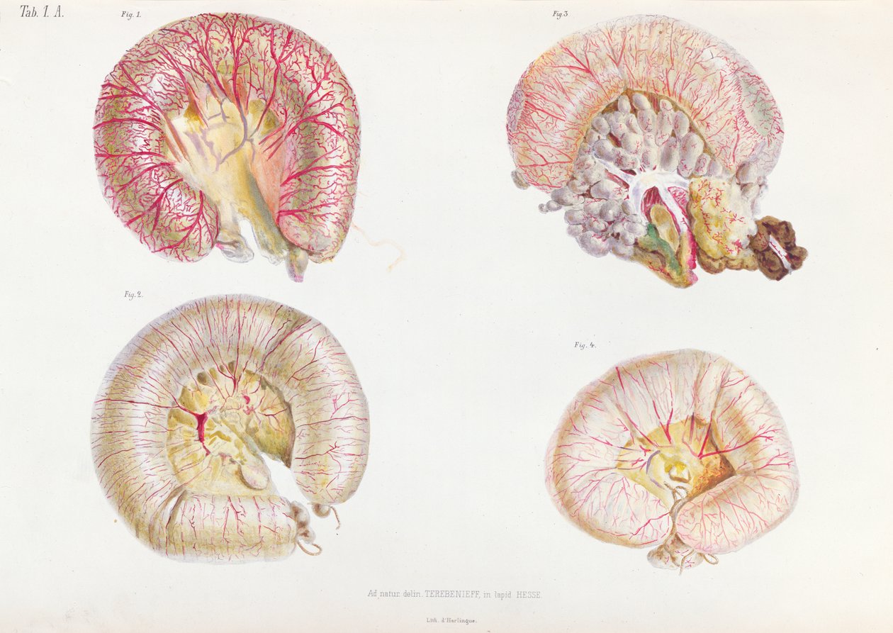 La superficie externa de los intestinos infectados con cólera, de Anatomie Pathologique du Cholera Morbus, por Nikolai Ivanovich Pirogov (1810-81) publicado en San Petersburgo, 1849 de Russian School