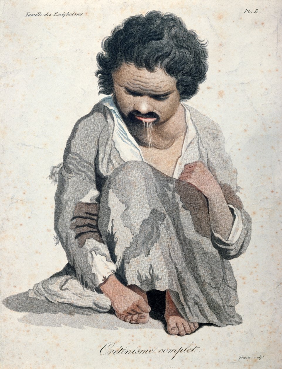 Cretinismo total, de un libro de Baron Jean Louis Alibert (1768-1837) de Salvadore Tresca