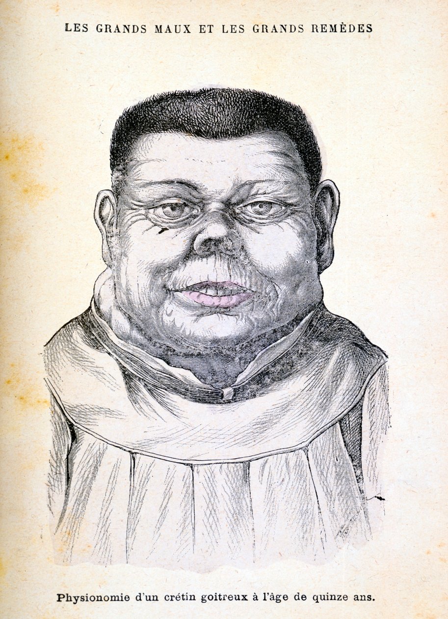 Cretino de 15 años, c1890 de Unbekannt