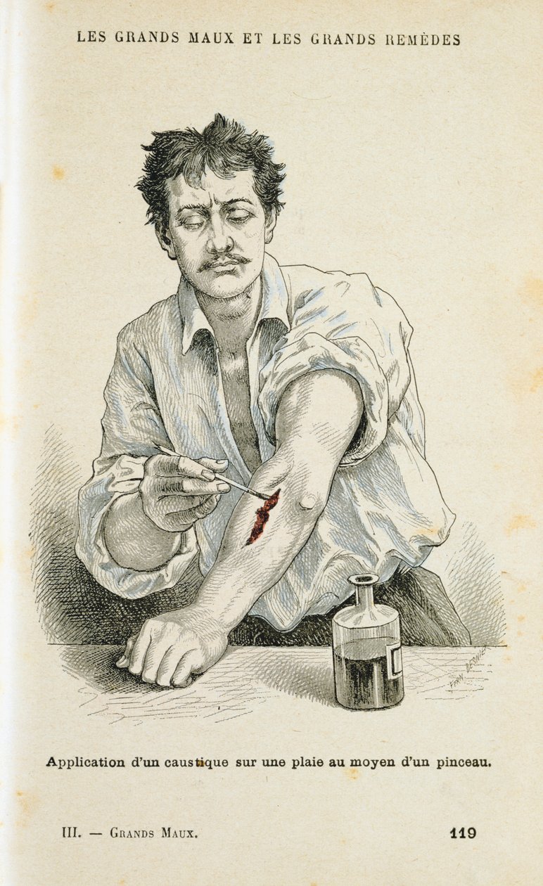 Pintando una herida con una solución antiséptica, c1890 de Unbekannt
