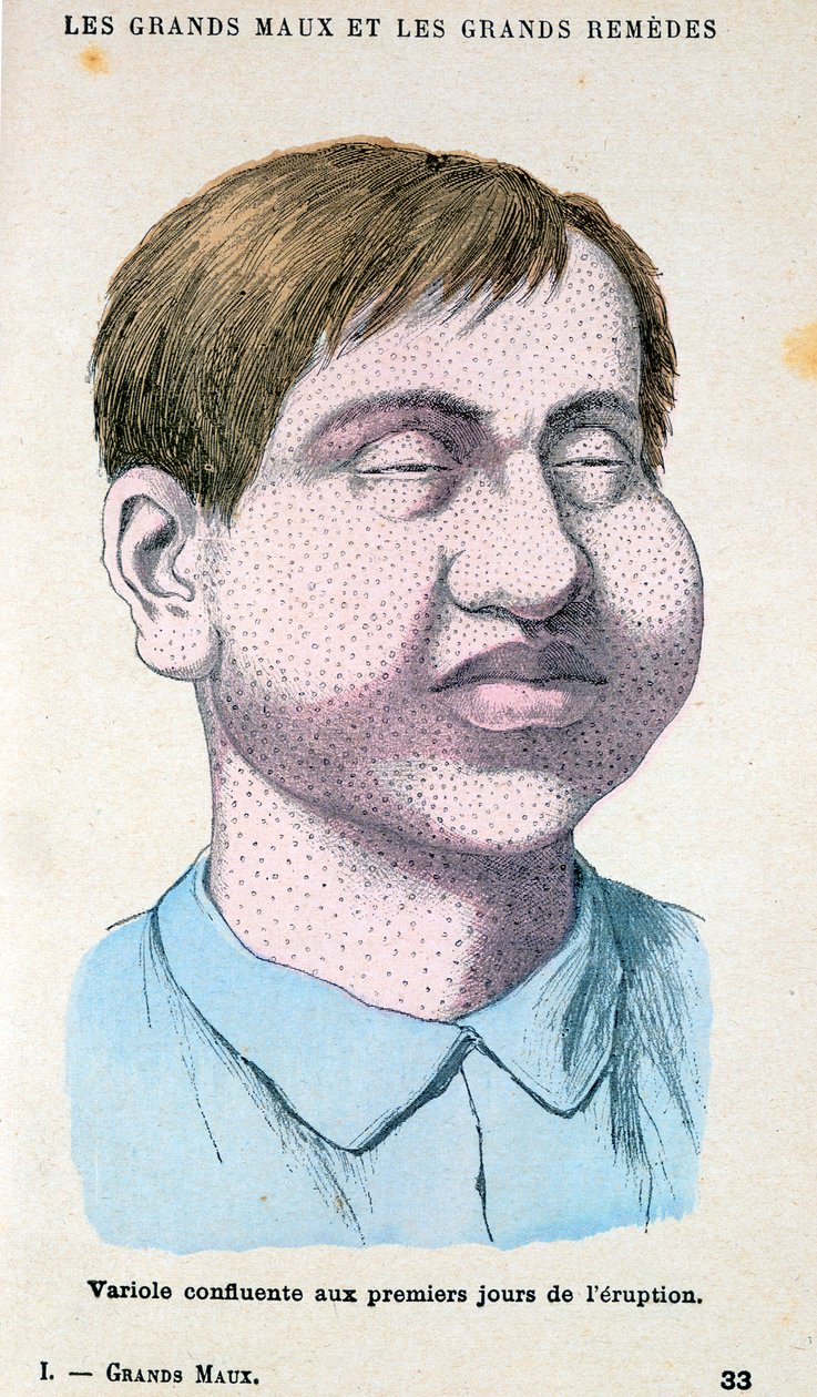 Víctima de la viruela, c. 1890 de Unbekannt