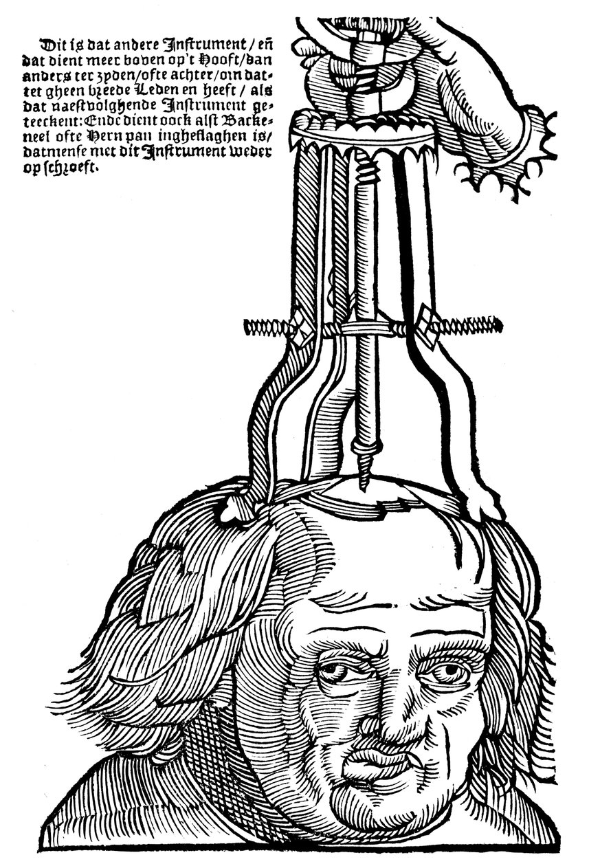 Trepanación, 1593 de Unbekannt