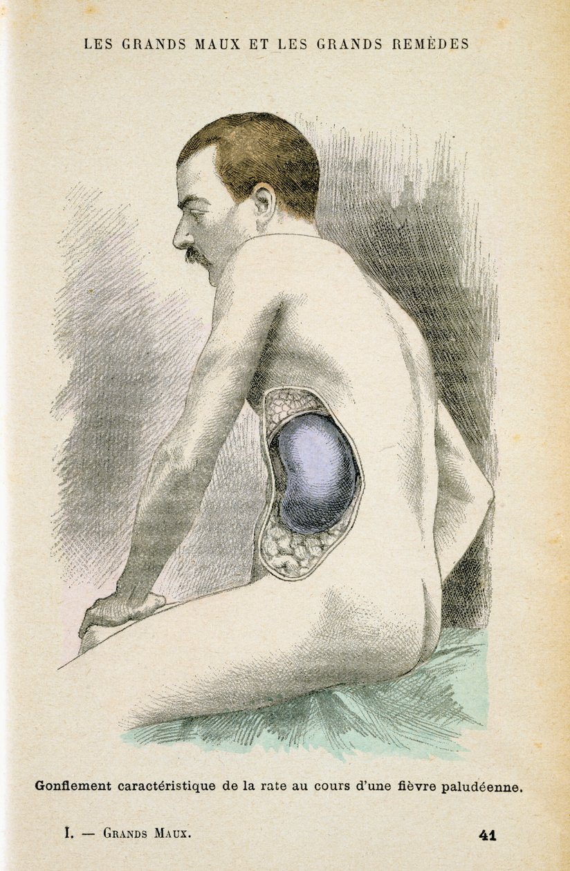 Bazo típico agrandado de un paciente con malaria, c1890 de Unbekannt