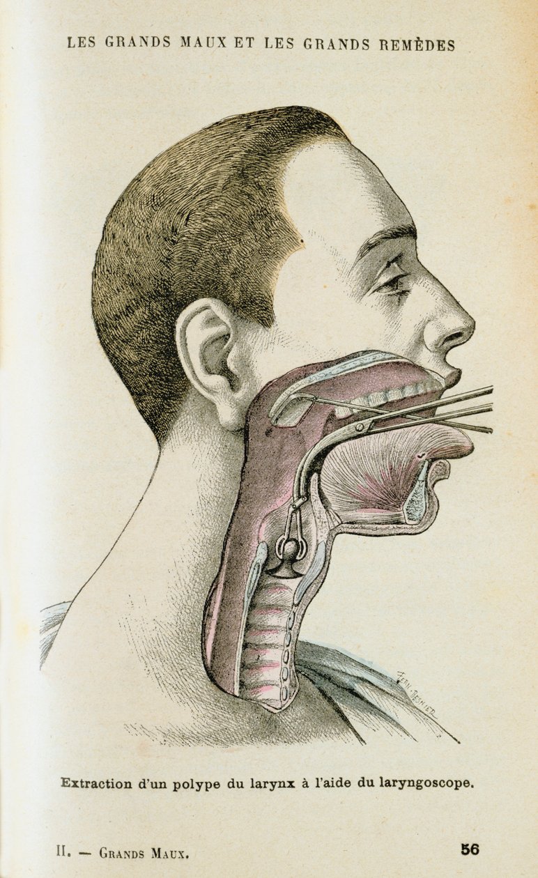 Uso de un laringoscopio para ayudar a la extracción de un pólipo de la garganta, c. 1890 de Unbekannt