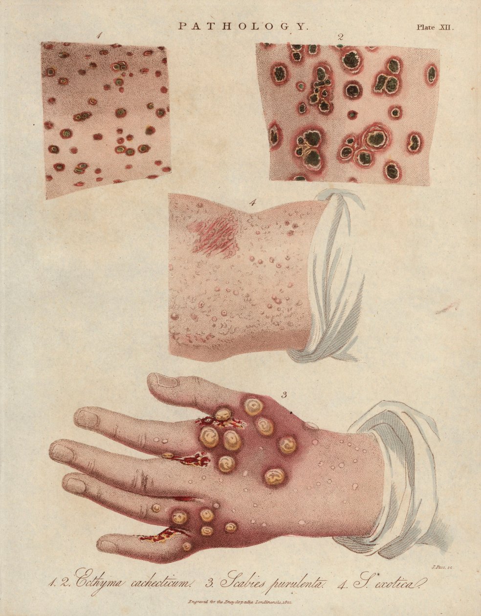 Úlcera cutánea, sarna purulenta y sarna causada por un ácaro sarcóptico scabiei - Litografía de John Pass, publicada en "Encyclopedia Londinensis" por John Wilkes, edición J.Adlard, Londres. de Unbekannter Künstler