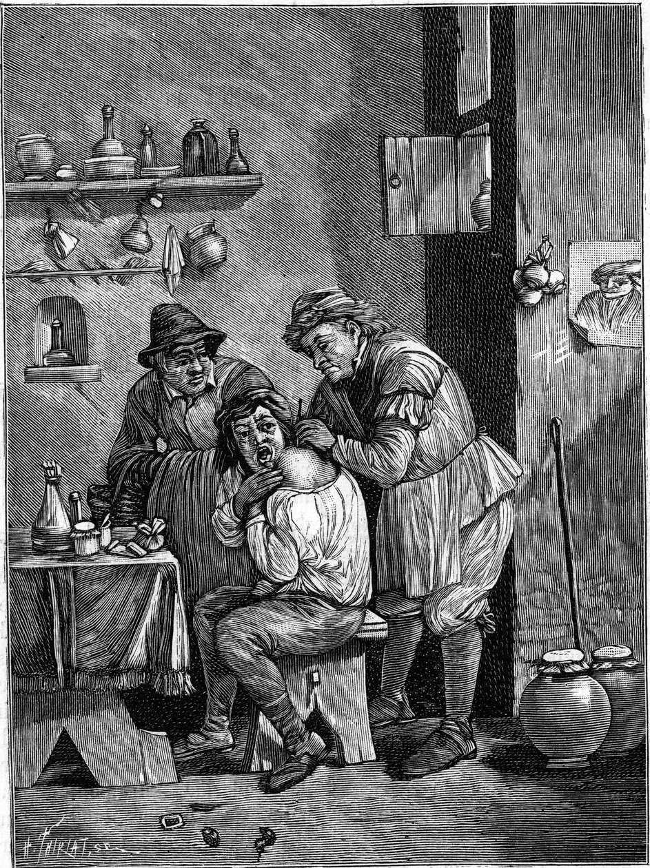 Un cirujano charlatán en el siglo XVIII examinando una lesión en el hombro. Grabado en “La Nature: revue des sciences et de leurs applications aux arts et a l