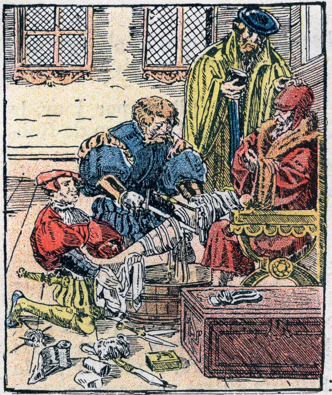 Amputación de una pierna en el siglo XVI. de Unknown artist