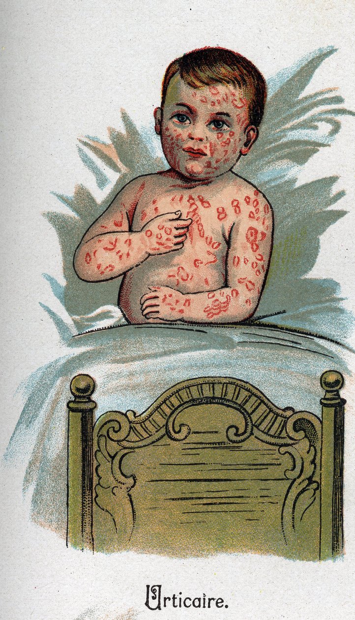Enfermedades infantiles: Urticaria. En “La nueva medicina natural” de F.E. Bilz de Unknown artist