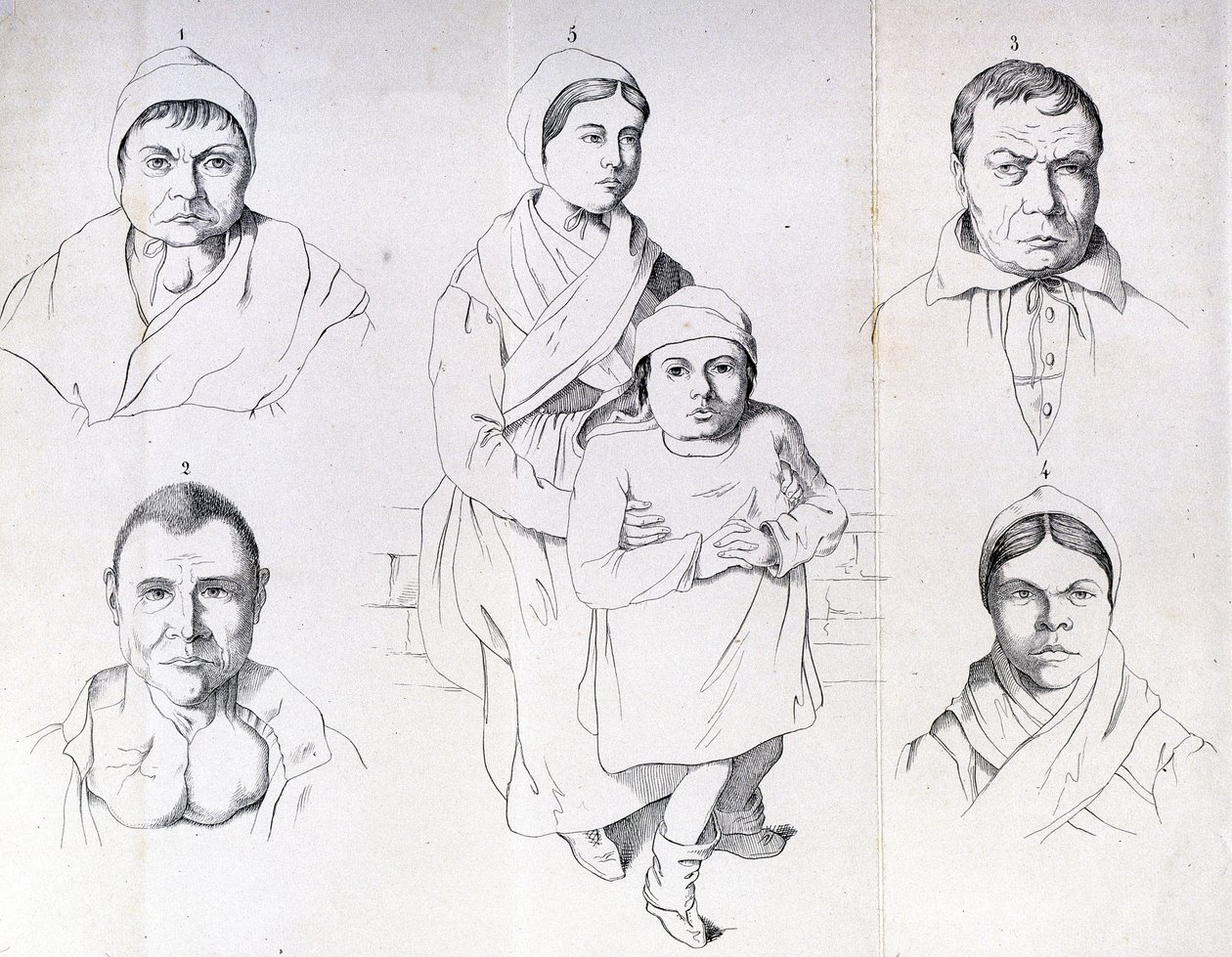 Consideraciones sobre las causas del cretinismo endémico por Morel. de Unknown artist