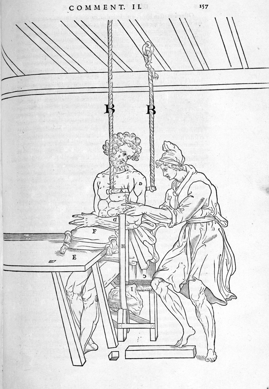 Reducción de fracturas. Placa ilustrada de “De dissectione partium corporis humani lbri tres...” por Carlo Stefano Riverio, París 1545 de Unknown artist