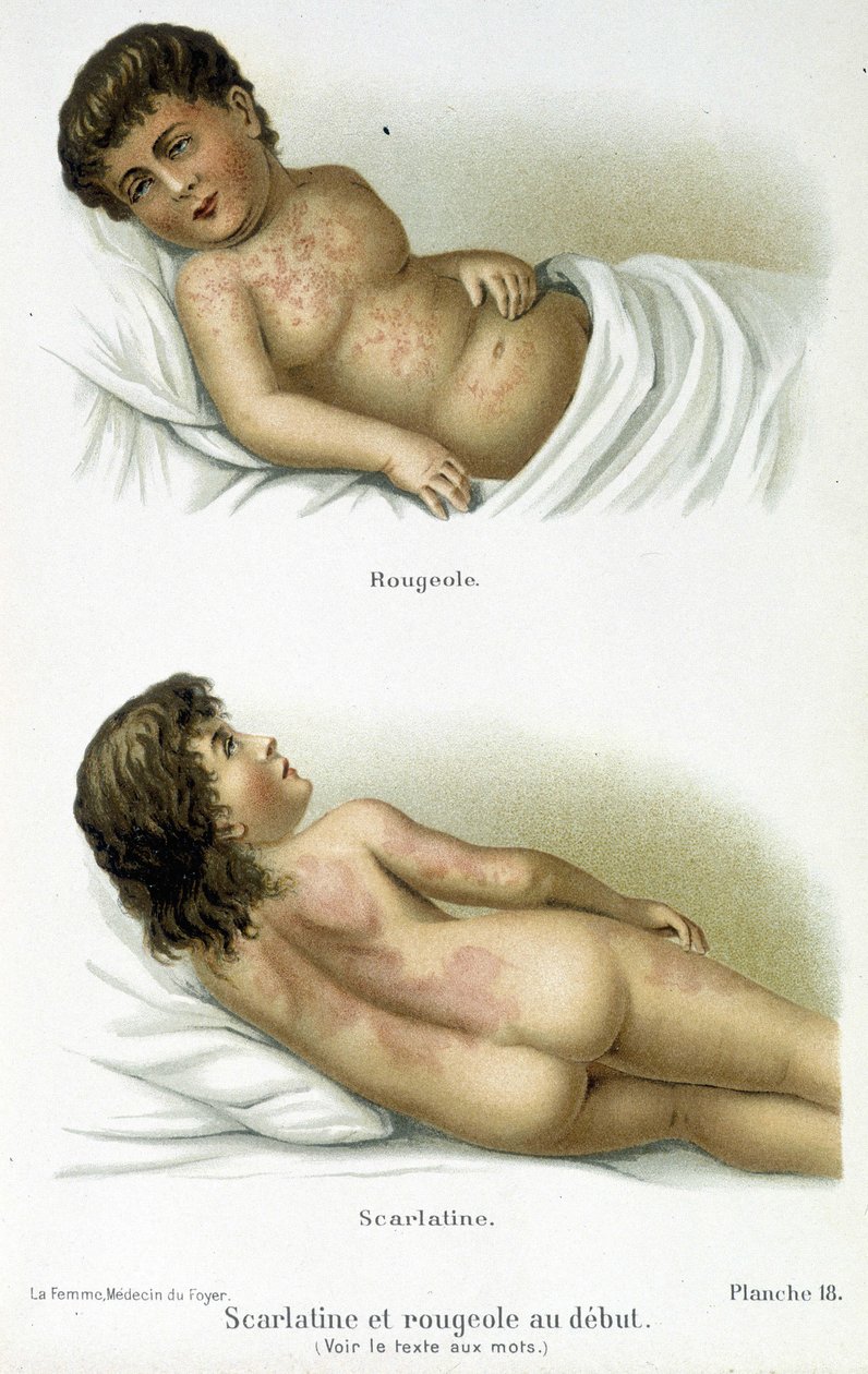 Escarlatina y sarampión - siglo XIX de Unknown artist