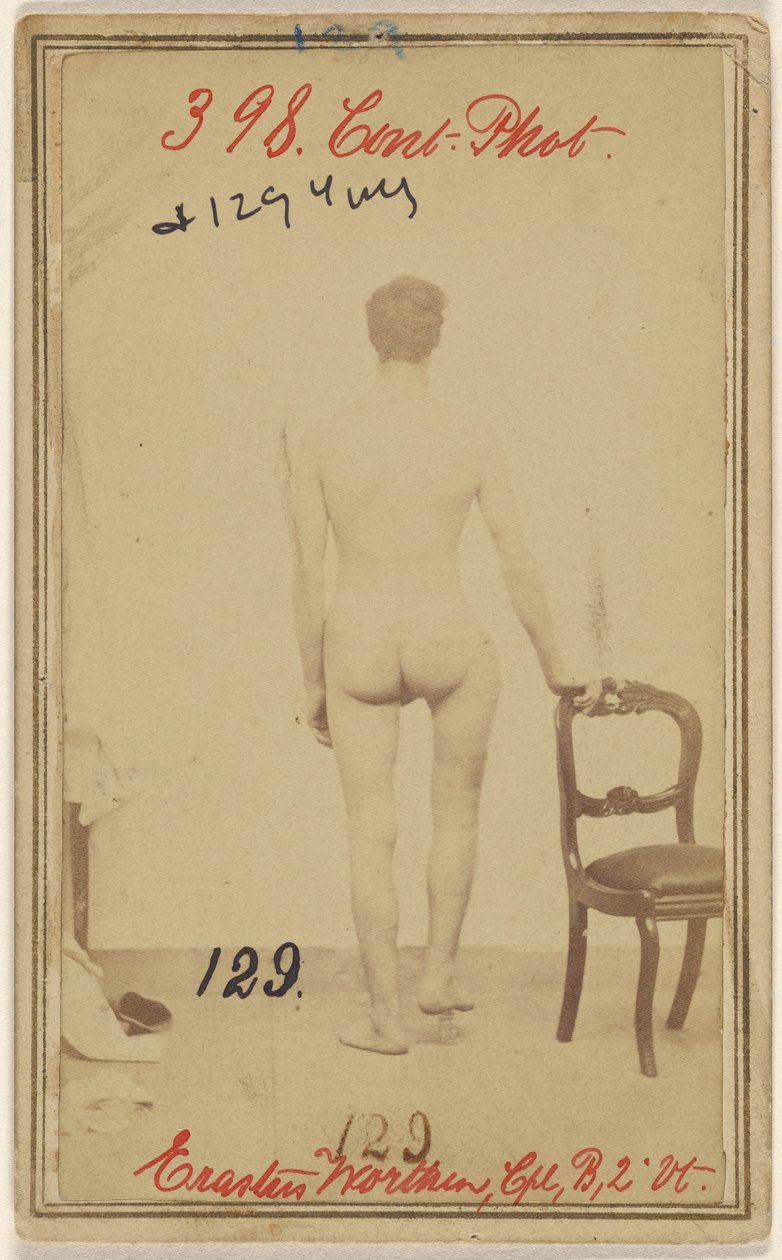 Fractura del tercio superior del fémur. Erastus Worthen, Cuerpo Co. B. 2nd Vermont Vols. 25 años - Residencia Stockbridge VT. de Unknown artist