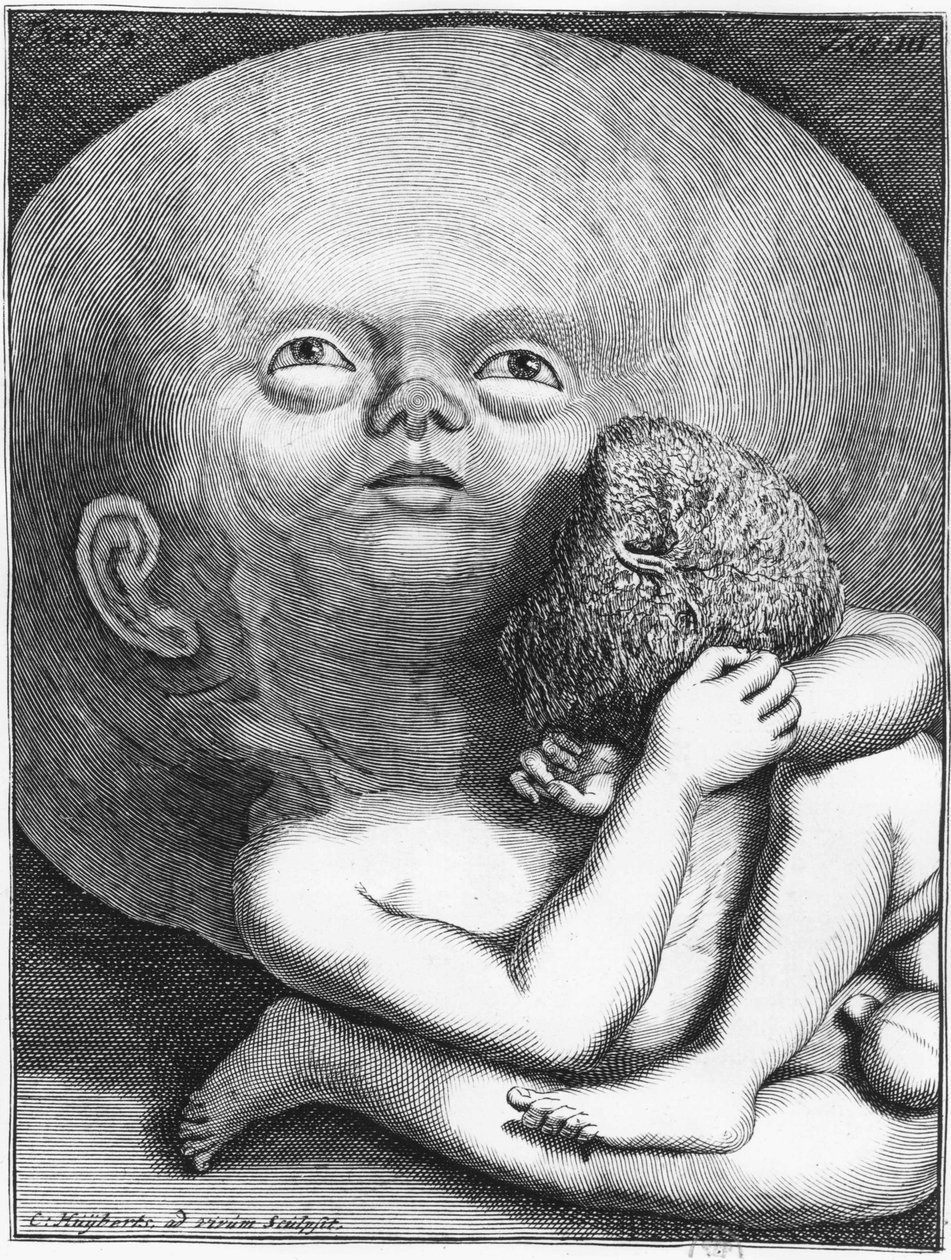 Monstruo: Niño hidrocefálico antropología - grabado, finales del siglo XVIII de Unknown artist