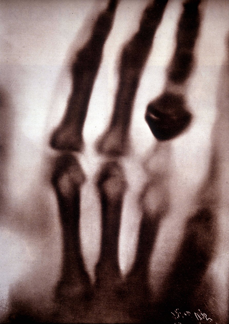 Rayos Roentgen (Röntgen) o rayos X. Primera fotografía: la mano de la esposa de Roentgen. 22/12/1895. de Unknown artist