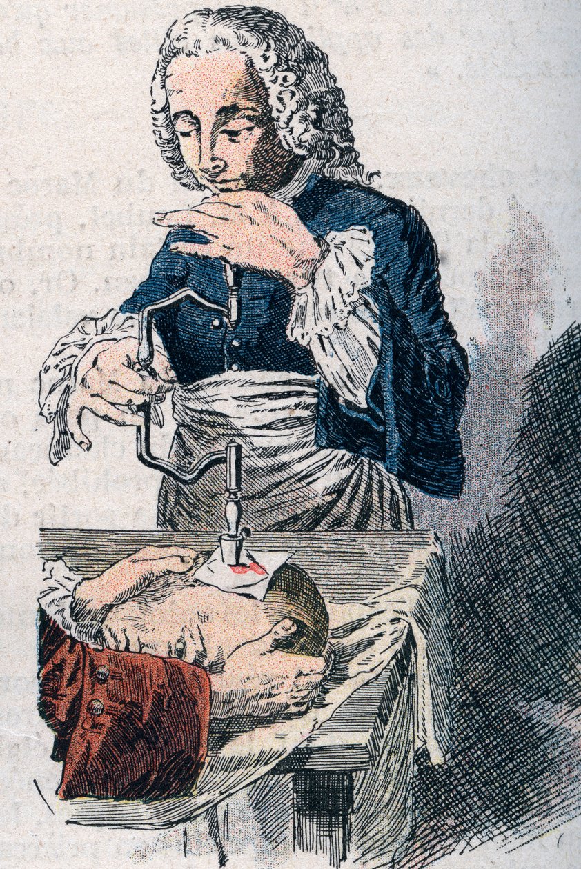 La trepanación. Estampa del siglo XVIII. de Unknown artist