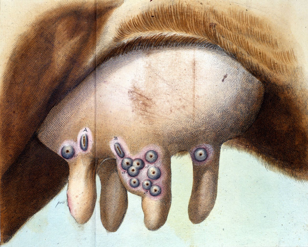 La ubre de la vaca utilizada para inocular la vacuna contra la viruela por Luigi Sacco (1769-1836) en enero de 1801. Lámina médica de “Tratado de Vacunación” de Luigi Sacco, Milán de Unknown artist