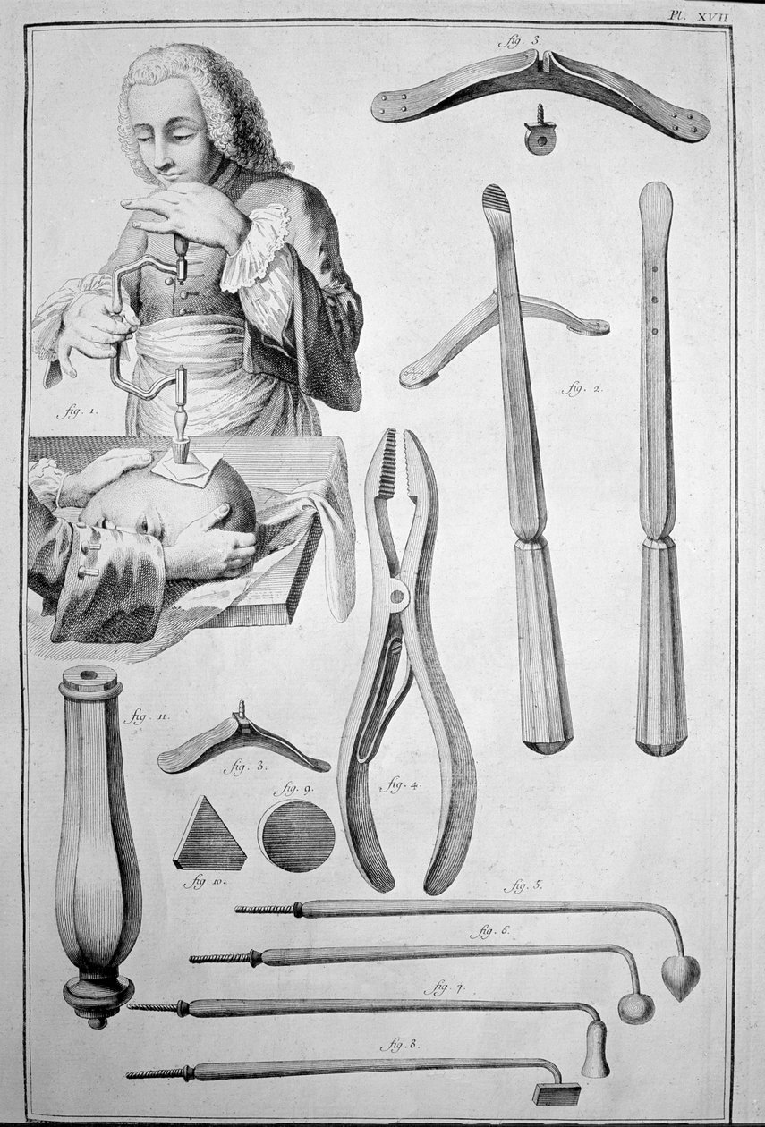 Trepanación del cráneo, varios instrumentos (grabado) de Unknown artist