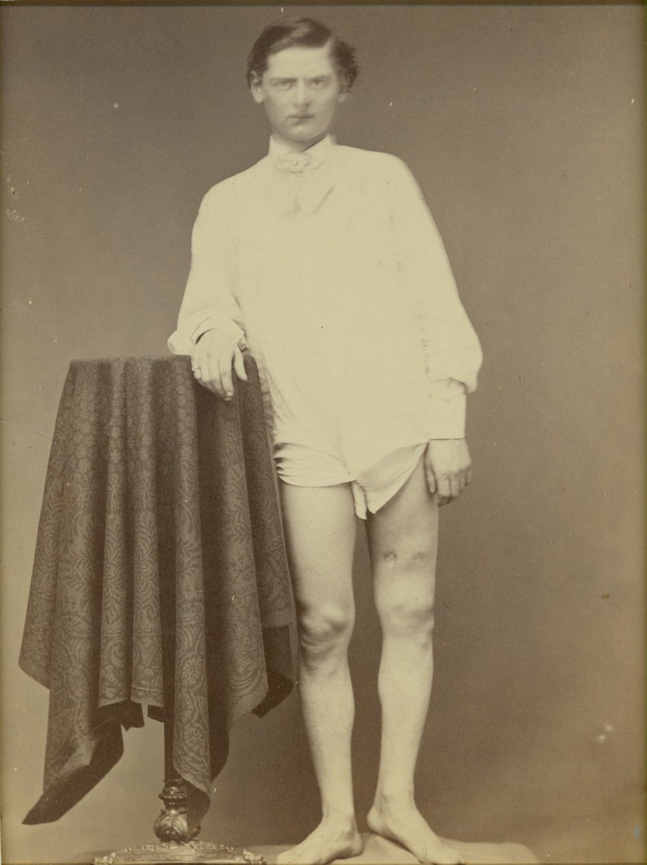 Soldado herido de la Guerra Civil (Charles Westerfield, Museo Médico del Ejército, Especimen No. 4278), abril de 1865 de William Abraham Bell