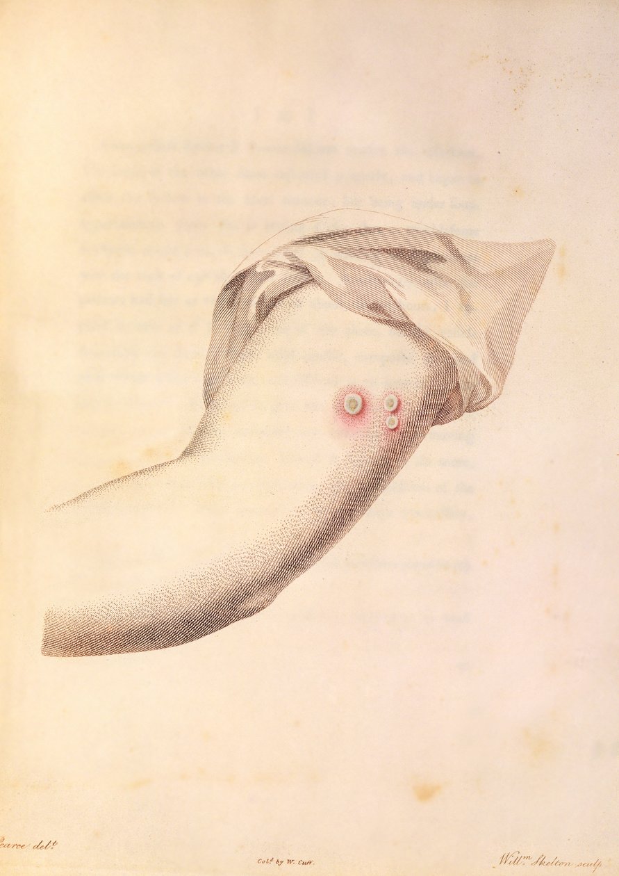 Brazo de William Pead usado para la vacuna contra la viruela, de 