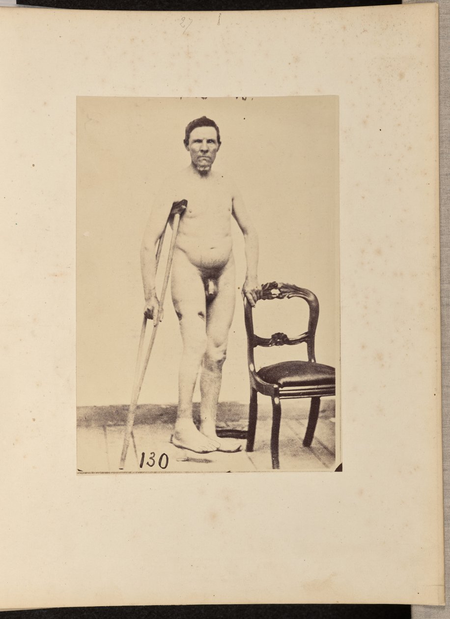 Fractura consolidada por disparo del tercio medio del fémur derecho de William H. Bell