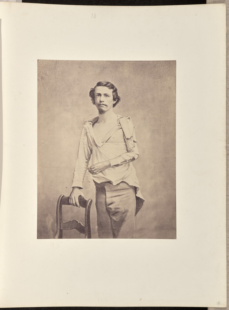 Extirpación con éxito de la cabeza del húmero izquierdo, seguida de necrosis y extirpación secundaria del resto del húmero y de las extremidades superiores del radio y el cúbito. de William H. Bell