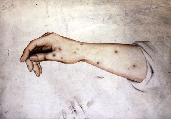 Estudio de un antebrazo con condición de la piel, c.1850 de William Lover