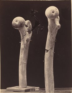 Especímenes de fracturas de fémur por disparo de American 19th Century