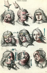 Cirugía en el siglo XVIII: Trepanación y operación del ojo y la cara. Grabado en 