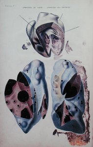 Apoplejía del corazón y de los pulmones, placa de ilustración de 