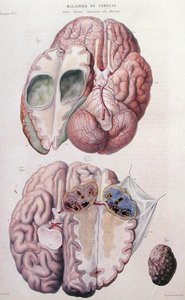 Tumores cancerosos del cerebro, de 