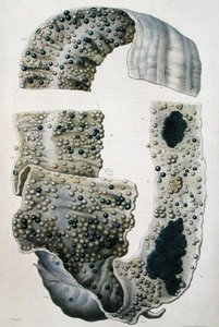 Enfermedades de los intestinos, de 