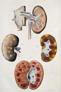 Enfermedades de los riñones, de 