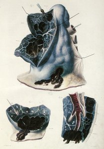 Enfermedades de los pulmones, de 