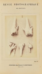 Múltiples exostosis simétricas, fémur, tibia