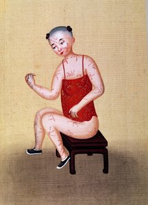 Niño con viruela