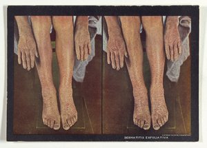 Dermatitis exfoliativa