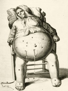 Drenando líquidos de un absceso, de Exercitationes Practicae circa Medendi Methodum por Frederik Dekkers, 1694 de Dutch School