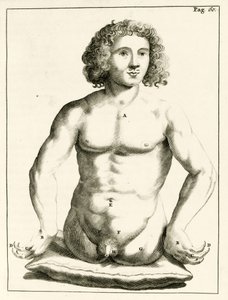 Ejemplo de defectos congénitos, de Exercitationes Practicae circa Medendi Methodum por Frederik Dekkers, 1694 de Dutch School