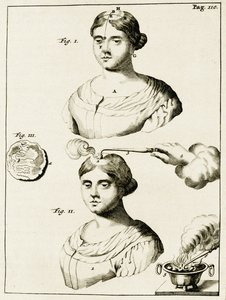 Tratando a un paciente con epilepsia, de Exercitationes Practicae circa Medendi Methodum por Frederik Dekkers, 1694 de Dutch School