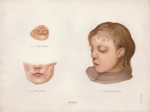 Enfermedades de la Piel: Herpes de English School