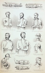 Tratamiento Temporal de Fracturas, c.1890 de English School