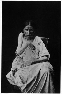 Fotografía de un paciente que sufre de epilepsia hemipléjica, en “iconografía fotográfica de la Salpetrière, Bourneville y P. Regnard, París de French Photographer