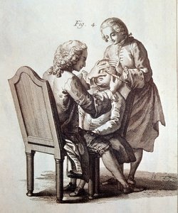Un médico operando a un paciente de cataratas, ilustración de la Enciclopedia Médica de Denis Diderot y Jean le Rond d