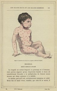 Aspecto y distribución de las manchas del sarampión al inicio de la erupción de French School